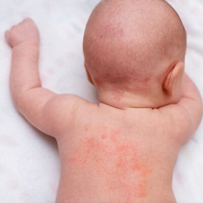 How Gentle Ingredients Help Manage Baby Eczema and Rashes