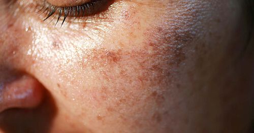 uneven skin tone causes