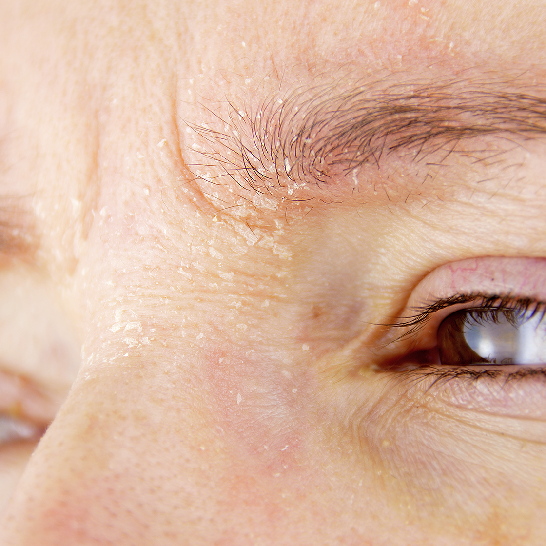 How Salicylic Acid Works on Oily and Acne-Prone Skin
