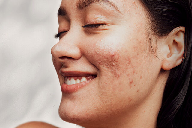 Salicylic Acid vs Benzoyl Peroxide for Acne Care